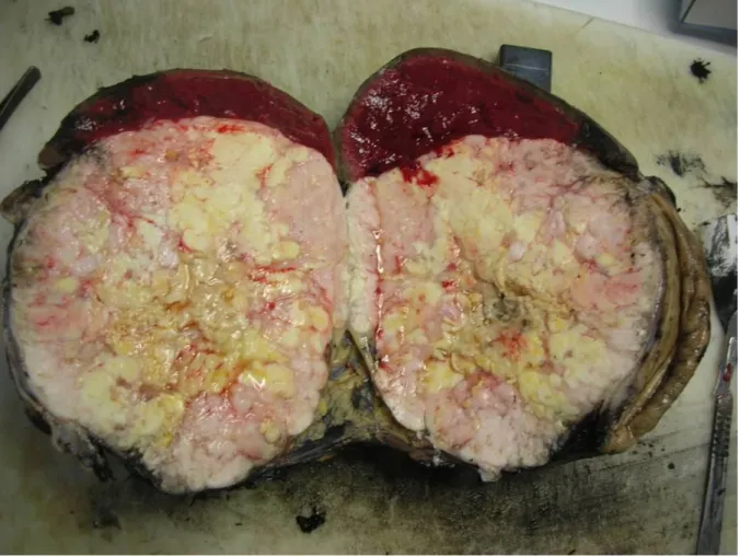 Figure 9 : Aspect macroscopique de la tumeur montant une masse qui refoule le hile et  l’estomac sans l’envahir
