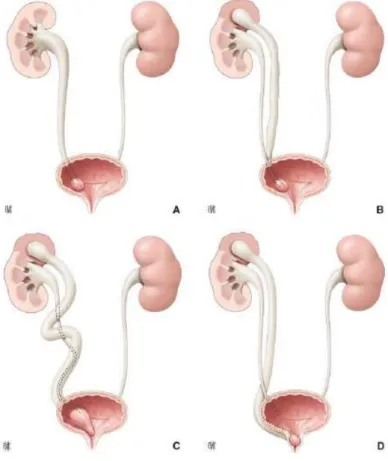 Figure 9 - Les quatre principaux types d'urétérocèle (selon Bruézière) IV. CLASSIFICATION :          