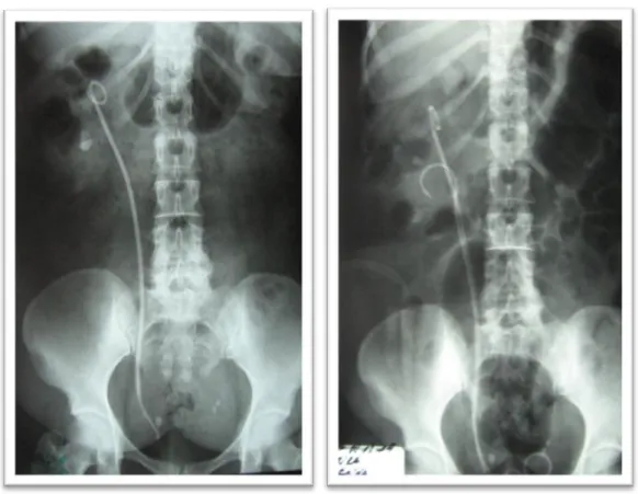 Fig. 19: ASP d'une patiente avec calculs caliciels inférieurs avant et après URSF montrant  la persistance d'un fragment résiduel après une seule séance