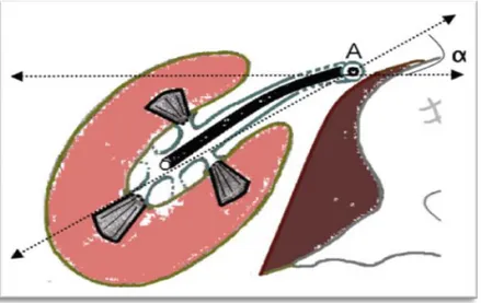 Fig. 35: Coupe transversale du rein droit. A. axe urétéral de l’URS. α. angle entre l’axe urétéral et  l’axe du pyélon rénal (30 à 50◦)