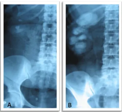 Fig. 25: UIV montrant la présence de deux lithiases rénales droites (A) avec une dilatation pyélo- pyélo-calicielle (B).