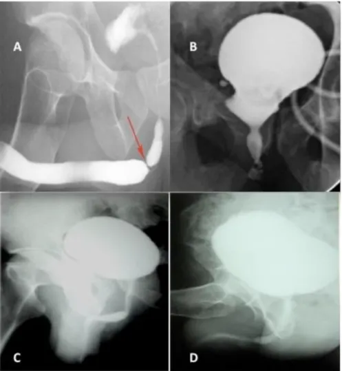 Fig1 : A Urethrographie pré opératoire d’un patient de 24 ans   présentant une sténose de l’urètre bulbaire d’étiologie inconnue