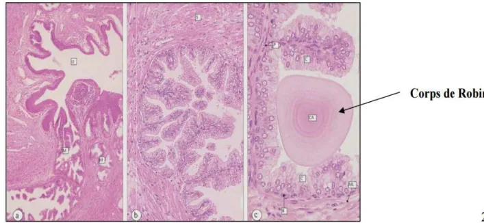 Figure 10 : histologie de la prostate montrant les corps de robin: 