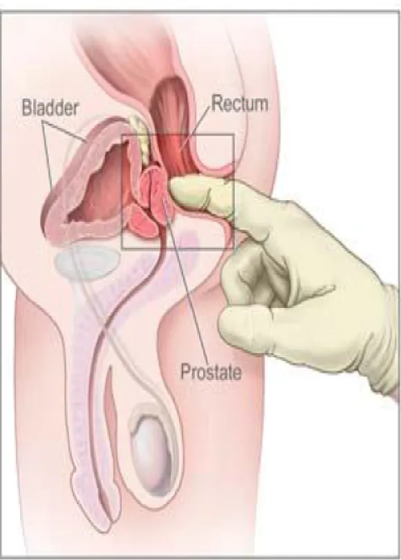 Figure 5 : abord postérieur de la prostate lors d’un toucher Rectal. 