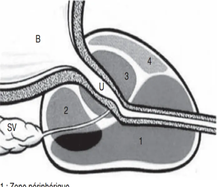 Figure 6 : anatomie zonale de la prostate selon Mc Neal (Coupe sagittale). 