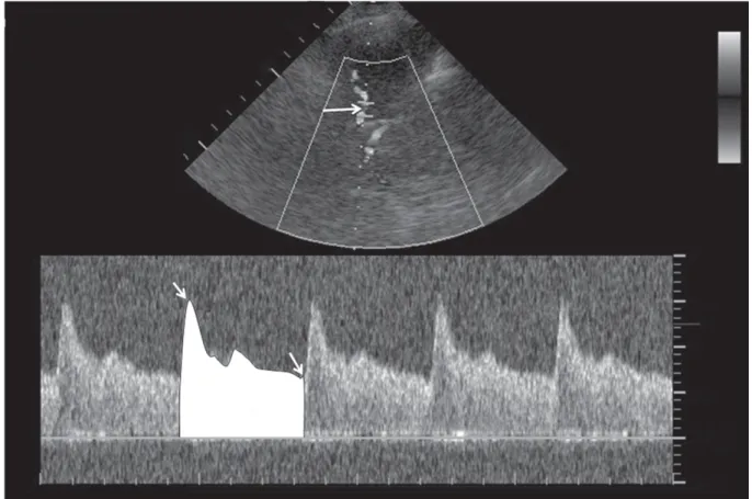 Fig. 8: Doppler transcrânien bidimensionnel : le signal Doppler est enregistré à partir du  segment proximal de l’artère cérébrale moyenne