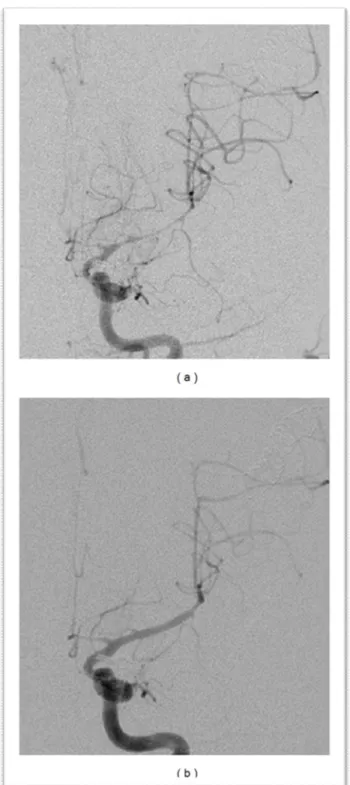 Fig. 9: Angiographie par soustraction numérique montrant un vasospasme sévère de l’ACM 
