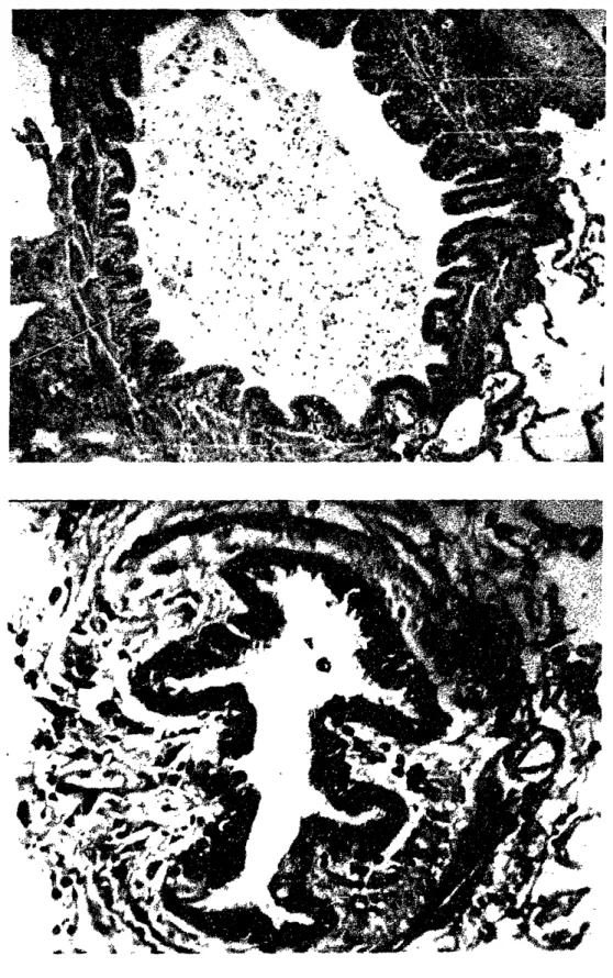 FIGURE  1-7: Another two cross-sections of airways from relatively normal  (top) and highly asthmatic (bottom) human subjects