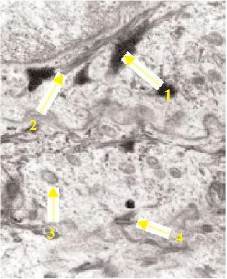 Fig. 7. Les kératinocytes de la couche granuleuse de l’épiderme  en microscopie électronique  1 = grains de kératohyaline  2 = tonofilaments  3 =kératinosome  4 = desmosomes 