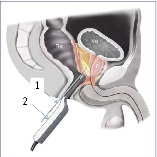 Figure 9: Biopsie prostatique écho-guidée par voie transrectale  85 .  1. Pistolet à biopsie