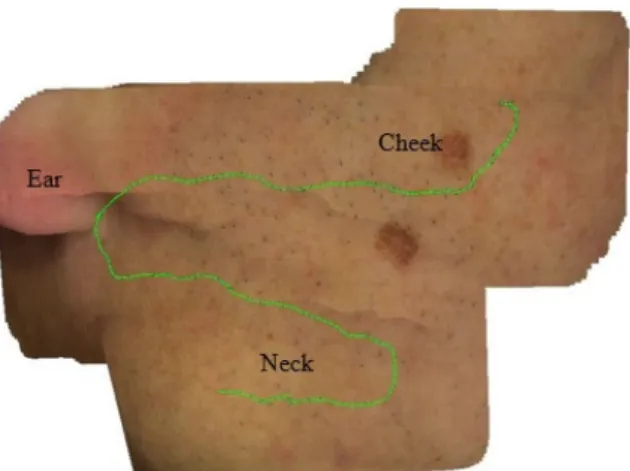 Fig. 3 gives another representative result in terms of skin mo- mo-saics obtained from a video-sequence acquired on the left facial part with some neck region on a patient