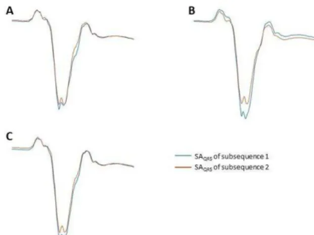 Figure  3:  Comparison  between  two  SA QRS   from  two  subsequences  (100  beats  averaged)  within  the  same  recording from dataset 3