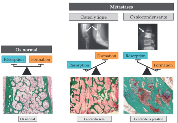 Figure 12. Visualisation de l'os en conditions physiologiques et métastatiques en radiographie et en  histologie