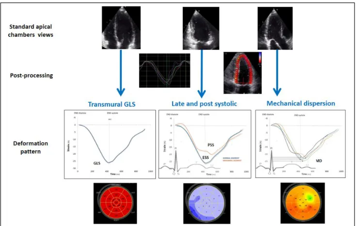Figure 1. Longitudinal Strain Curves Measured by Speckle Tracking Echocardiography  with Deformation Pattern of a Segment normal segment with Transmural Strain 