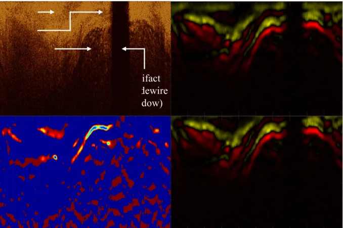 Figure 2.3. Identifying the edge contours corresponding to the outer border. (Top Left) The original flattened  image on which the operations were performed; substantial fatty plaque (*) partly obscures abluminal structures  of the vessel wall
