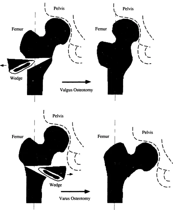 Figure  1.2: Valgus versus Varus Intertrochanteric Osteotomies