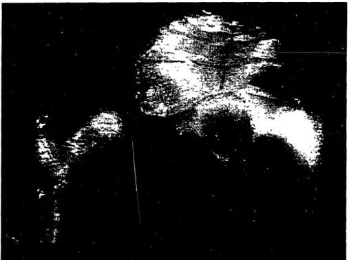 Figure 2.13:  Stereolithographic Reconstructions of Femur and Hemi-Pelvis.