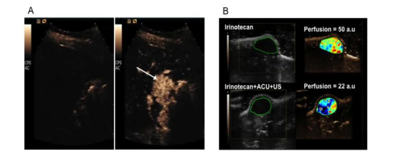 Figure 1 – A : diagnostic médical : avant injection des ACUs (à gauche), l’imagerie ultrasonore ne détecte aucune anomalie physiologique au niveau du foie