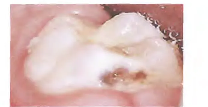 Figure 1 :  carie sur la face proximale de molaire temporaire  (Badet et Richard, 2004)