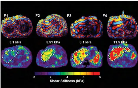 Figure  2.4  Stiffness  increase  in  the  liver  corresponds  to  increasing  fibrosis  level  (F1  to  F4)