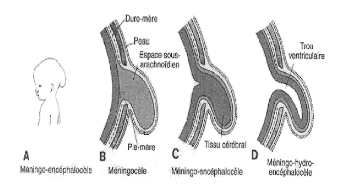 Figure 2 : Schémas représentant les différents types d’encéphalocèles. (Jan Langman et al,  1996) 