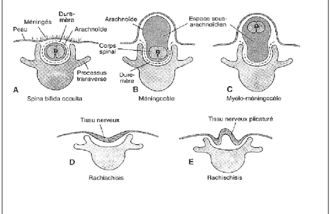 Figure 4 : Schémas representant les différents types de Spina Bifida. (Jan Langman et al,  1996) 