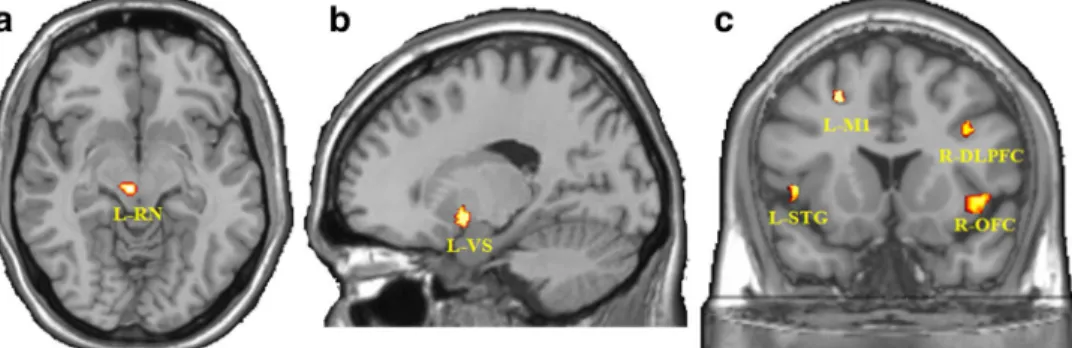 Fig. 4 Graphical display illustrating the psychophysiological interaction between the left red nucleus and right OFC for all subjects