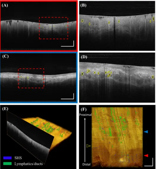 Figure 4. Visualization of automatically detected SHSs. (A) Volumetric laser endomicroscopy (VLE)  image with automatically detected SHSs under the BE region in polar coordinates