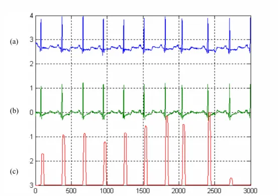 Figure 3.12. Résultat du filtrage adapté adaptatif sur le fichier 100 de MIT/BIH.  