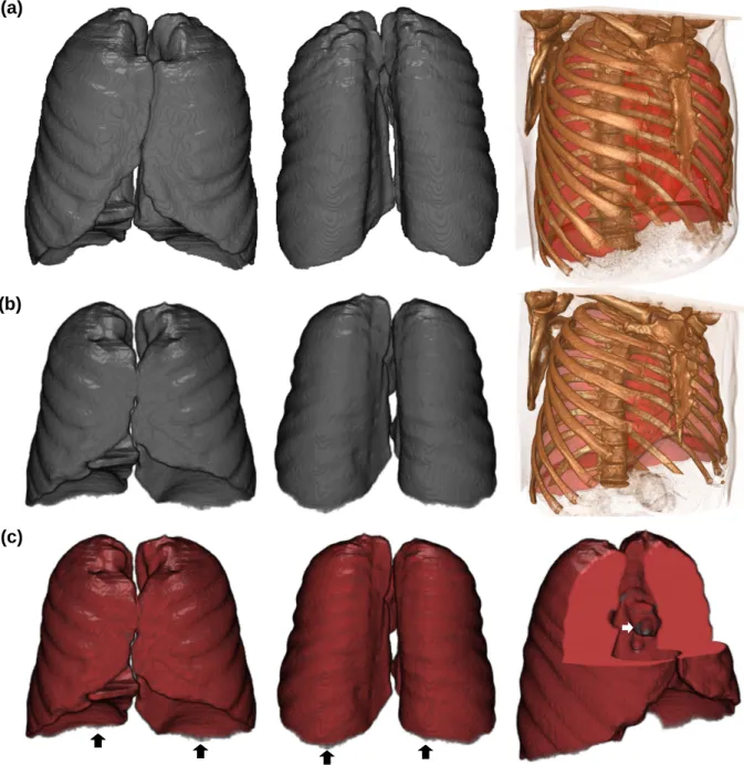 Fig. 5 Result of the Lung CT image registration: (a) Manual Lung segmentation in the atlas CT-image (at each column, from left to right: front view, back view, and 3D chest CT reconstruction embracing the Lung manual segmentation), (b) Manual Lung segmenta