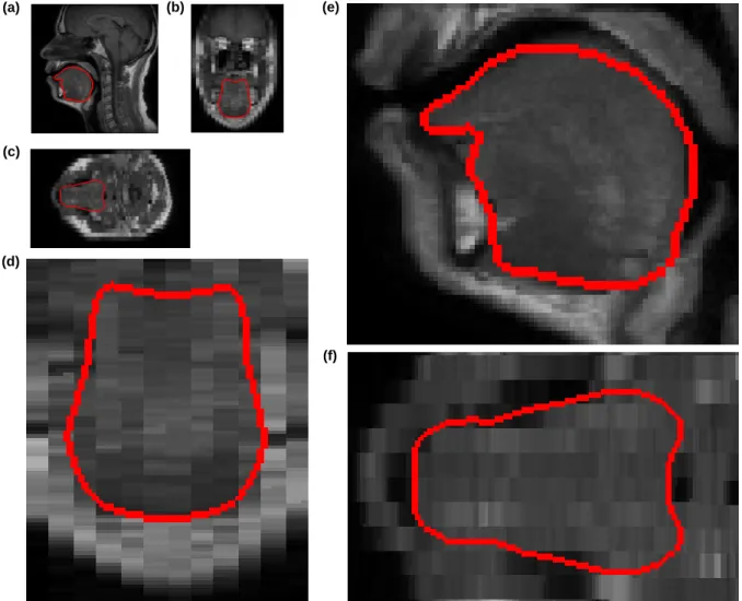 Fig. 8 Mesh derived tongue contours superimposed on the MR images and their enlargements (Normal #1) : (a) a Sagittal slice, (c) a Coronal slice, (d) an Axial slice, (d) enlargement of the tongue region in the Sagittal slice, (e) enlargement of the tongue 