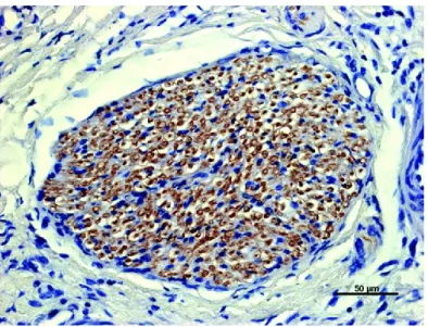 Figure 8 : Immunomarquage positif des antigènes du virus Nipah dans les axones du  nerf olfactif