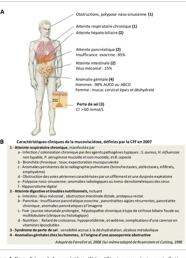 Figure  2.  Signes  cliniques  de  la  mucoviscidose.  (A)  Les  différents  organes  classiquement  affectés  par  la  mucoviscidose