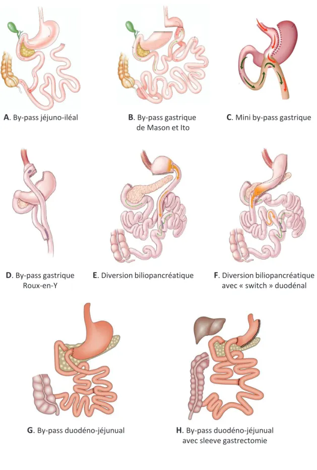 Figure 3 : Les chirurgies de type by-pass 