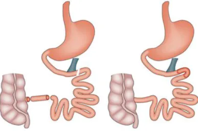 Figure 4 : Les autres techniques de chirurgie bariatrique  (D’après Rubino et al. 2010b) 