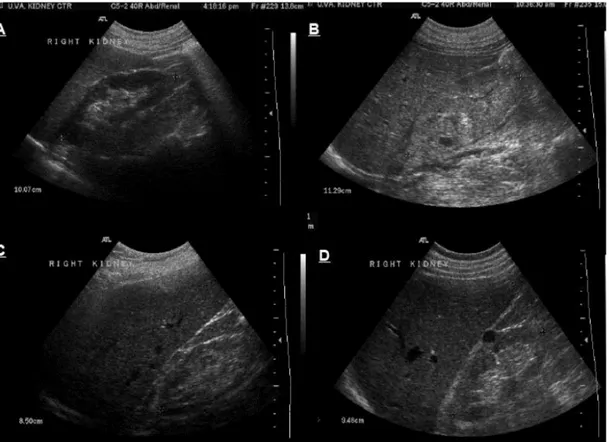 Figure 7. Ultrasonography of the kidney. (A) normal kidney, (B) enlarged and echogenic kidney with loss of differentiation between  cortical, medullary and sinus fat compartments in a case with acute kidney injury, (C) small, slightly echogenic kidney with
