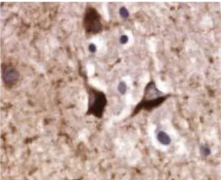 Figure  3 :  Dégénérescences  neurofibrillaires  révélées  en  immunohistochimie  par  des  anticorps anti- tau