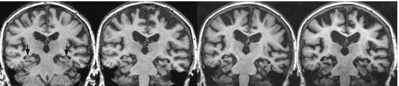 Figure 8 : Progression de l’atrophie cérébrale au cours du temps chez un patient atteint  d’une maladie d’Alzheimer