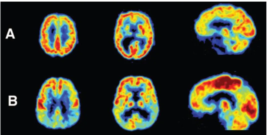 Figure  13 :  Imagerie  en  TEP-FDG  chez  un  patient  atteint  de  maladie  d’Alzheimer  en  comparaison à un sujet sain
