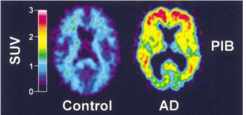 Figure  14 :  Patterns  de  fixation  de  PiB  chez  un  sujet  contrôle  et  un  patient  atteint  de  maladie d’Alzheimer (AD)