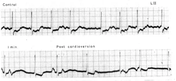 Figure  20 : Electrocardiogramme humain représentant une longue phase de fibrillation atriale,  objet  d’une  cardioversion  électrique