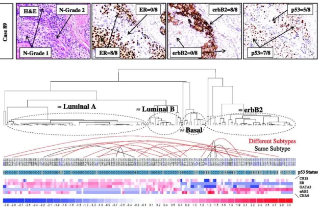 Figure 13: Diversity and existence of multi-subtypes within DCIS tumor  (a) IHC photos of one DCIS from a patient including different types of cancer cells 