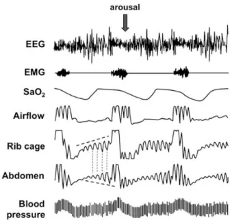 Figure 4.  Exemple d’enregistrement polysomnographique d’un patient présentant un SAOS d’après  Dematteis et al (4) 