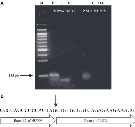 Fig. 2. NUP98eNSD1 transcript. (A) A specific 135-pb NUP98eNSD1 product is detected in bone marrow of the patient (P) at diagnosis by RT-PCR