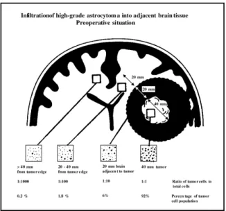 Figure 1:  Représentation  des  propriétés  infiltrantes  des  tumeurs  gliales  de  haut  grade  (en  situation pré-opératoire)