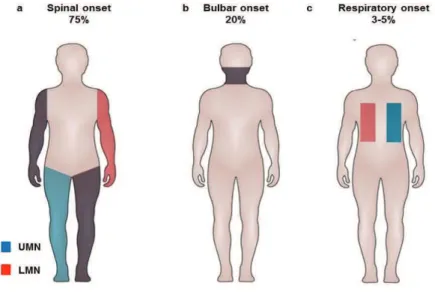 Figure 2. Site of onset in ALS 