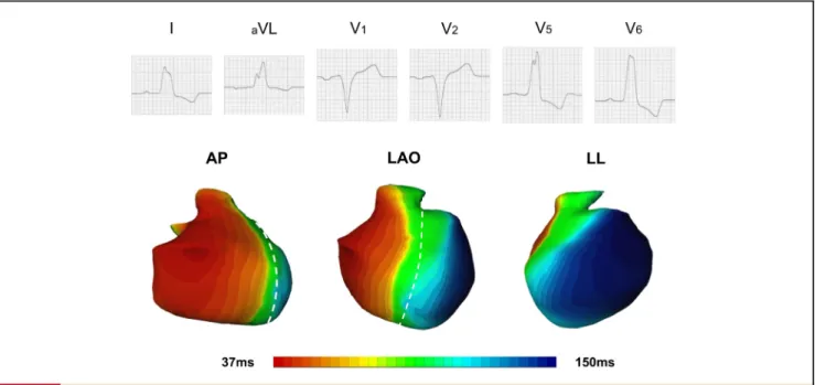 Figure 2 Electrocardiographic Activation Map of a Clinical Responder to CRT With a 12-Lead Surface ECG Exhibiting a Typical LBBB Activation Pattern