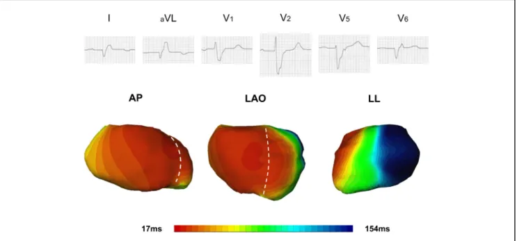 Figure 4 Electrocardiographic Activation Map of a Clinical Responder to CRT With a 12-Lead Surface ECG Exhibiting a NICD Activation Pattern