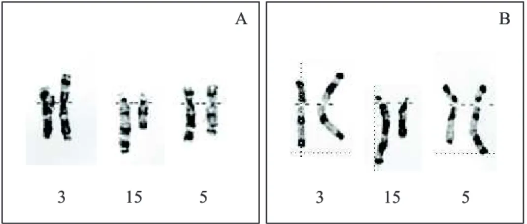 Figure  19  :  Représentation  des  chromosomes  3,  5  et  15  et  des  dérivés  3,  5  et  15  de  la  translocation t(3;15;5) en bandes G (A) et R (B) 