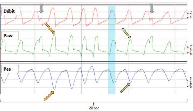 Figure  8 Enregistrement  d’un  patient  en  mode  PAV+.   Les courbes représentent (de haut en bas) : le débit  dans  les  voies  aériennes,  la  pression  dans  les  voies  aériennes  (Paw),  et  la  pression  œsophagienne  (Pes)